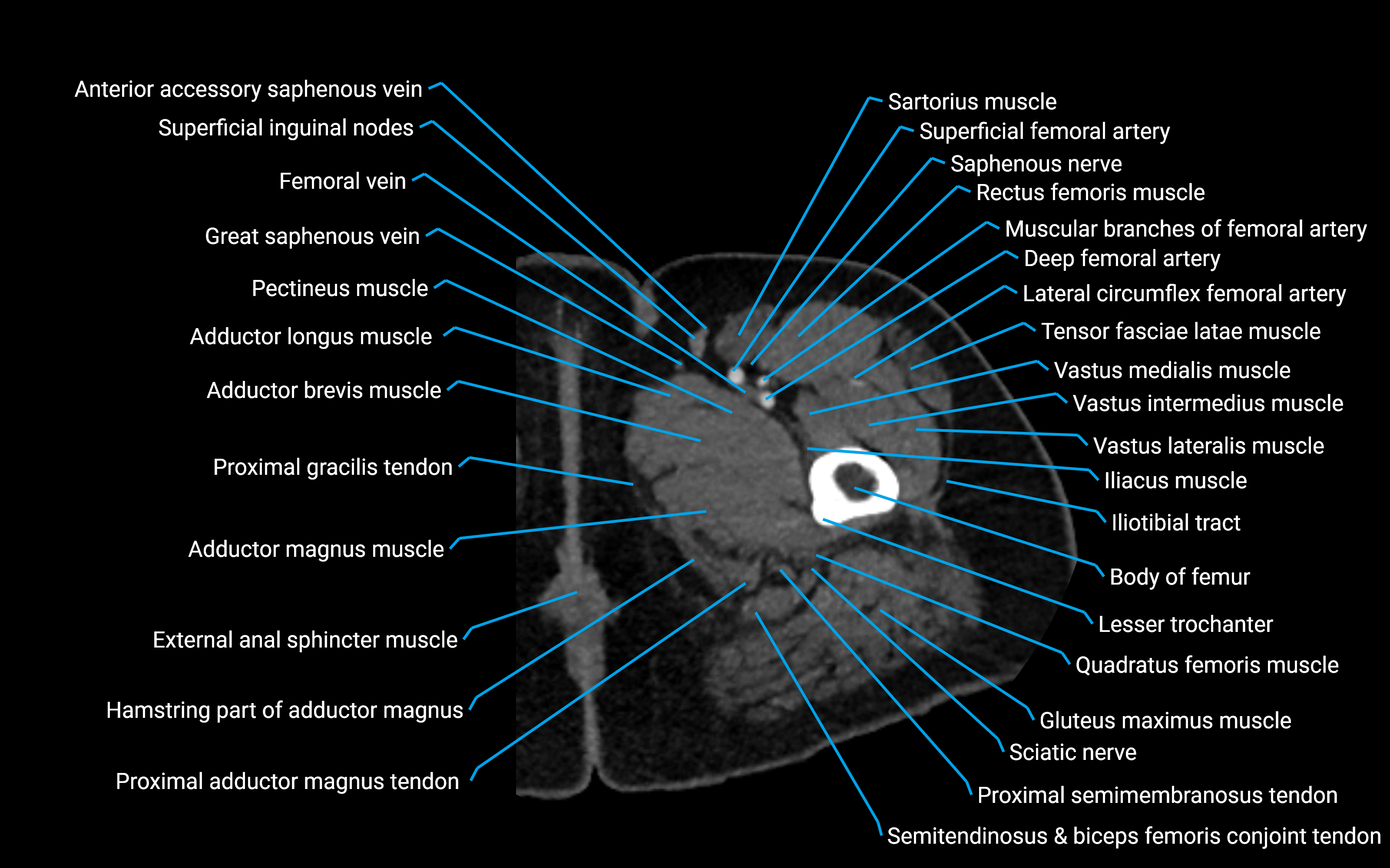 CT Hip axial cross sectional anatomy labelled image 20 (2).png